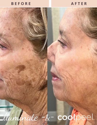 CoolPeel Before and After
