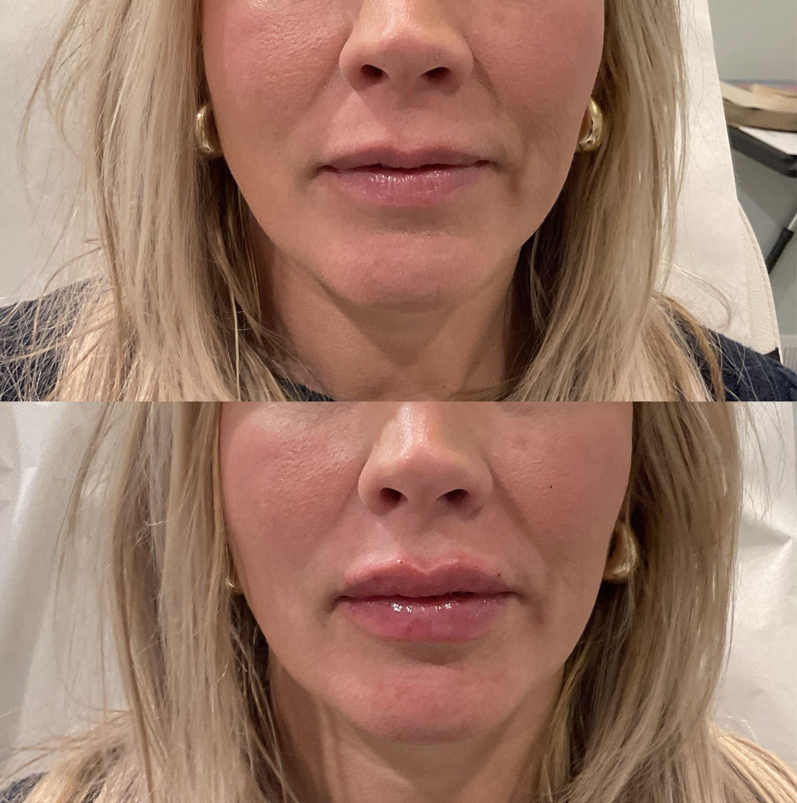 Lip augmentation before after photos Dunmore Pennsylvania