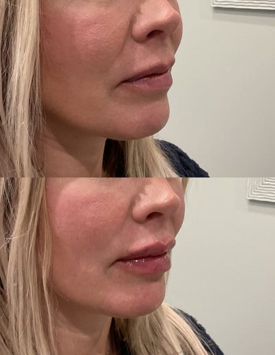 Lip filler before and after natural results Scranton PA patient 2