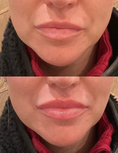 Lip injection results before after NEPA med spa patient 1