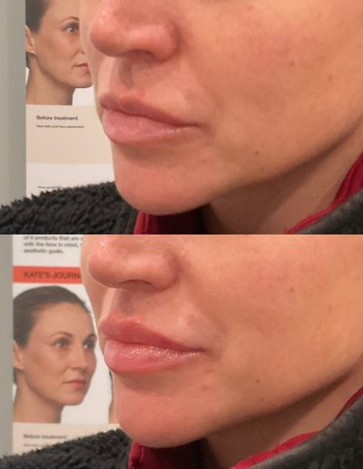 Lip filler before and after natural results Scranton PA patient 1