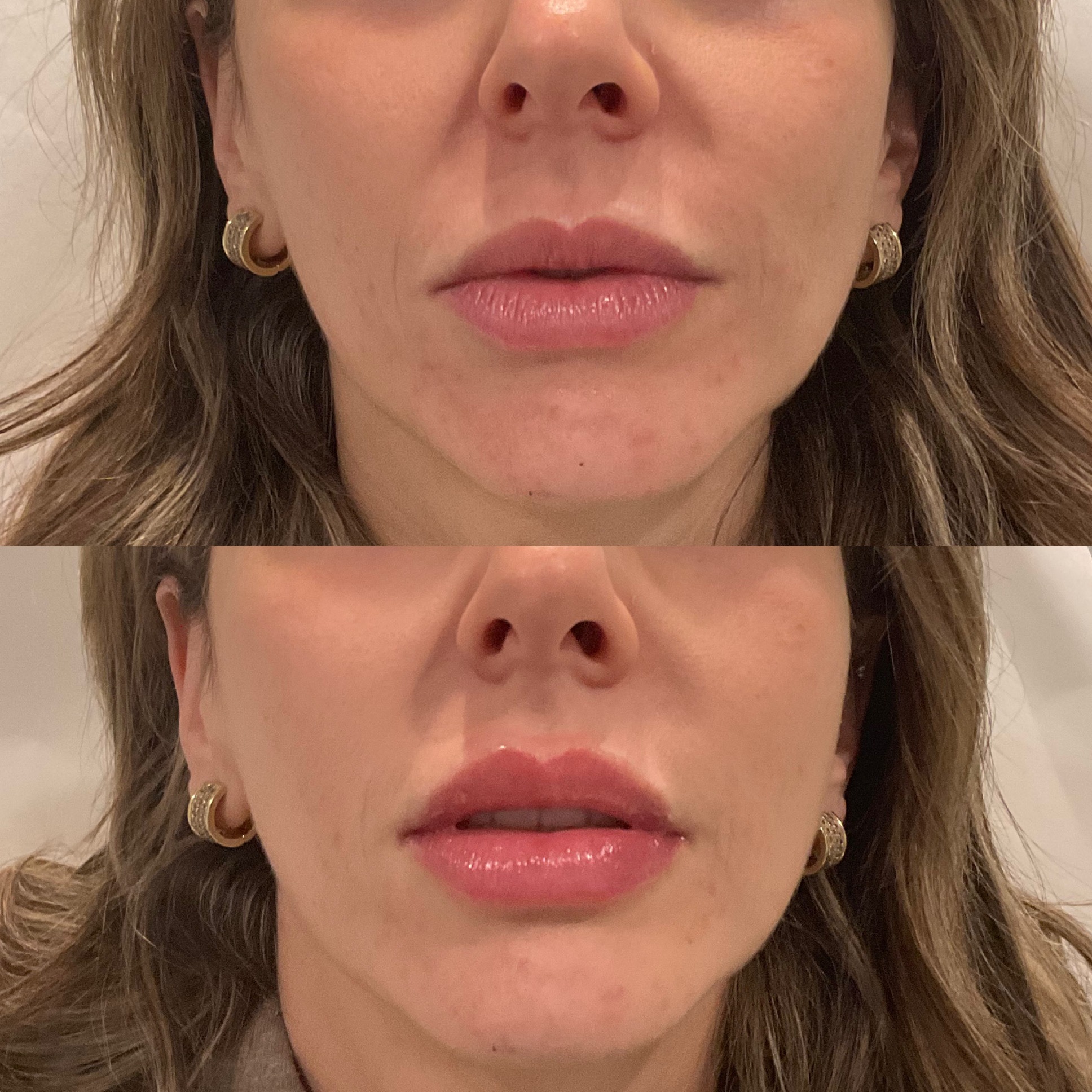 Lip Fillers Scranton before and after
