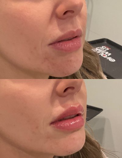 Lip filler before and after natural results Scranton PA