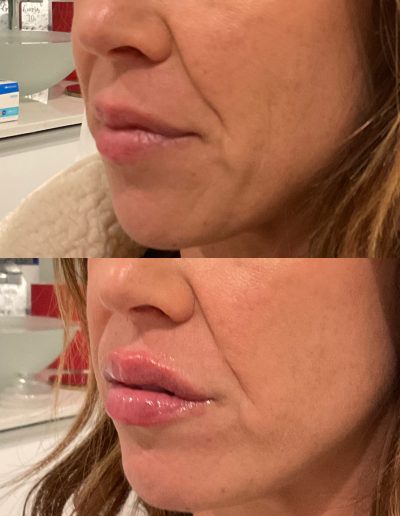 Lip injection results before after NEPA med spa patient