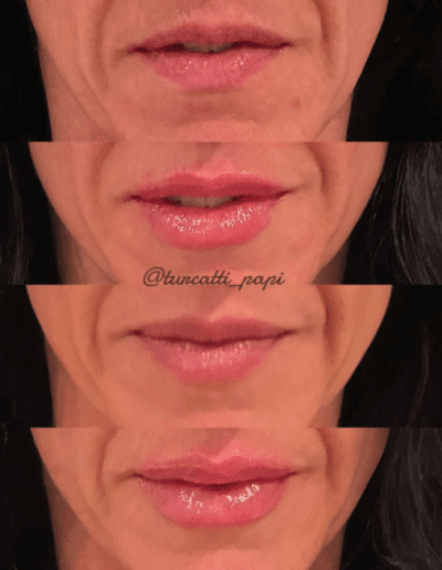 Lip augmentation before after photos Dunmore Pennsylvania patient 6