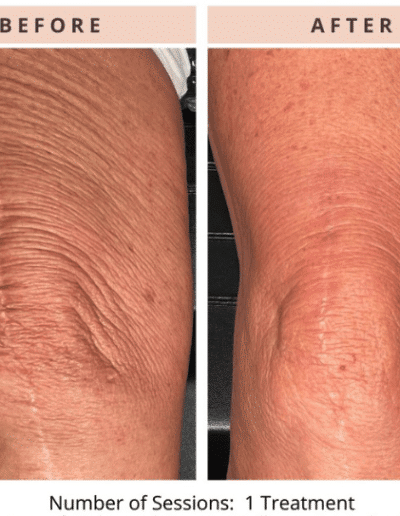 CoolPeelScranton PA CoolPeel CO2 Laser Before and After Results 2