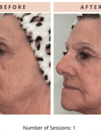 CoolPeelScranton PA CoolPeel CO2 Laser Before and After Results 4